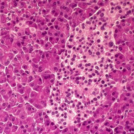 Pancreatic cancer: New drug extends lives but isn’t a cure